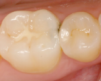 Photo of teeth with dental carries