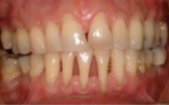 Periodontitis